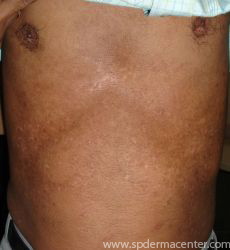 Vitiligo-After